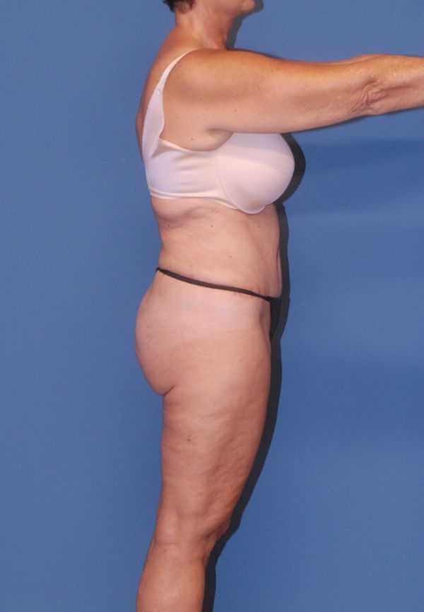 Abdominoplasty Before & After