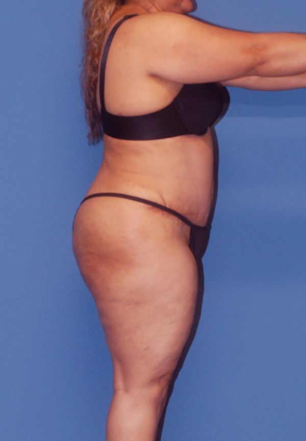 Abdominoplasty Before & After