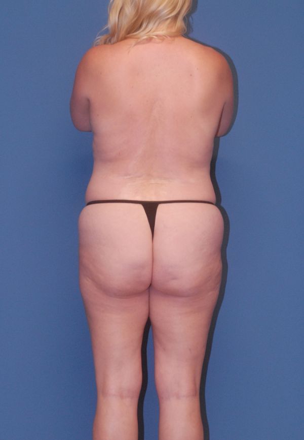 Abdominoplasty Before & After