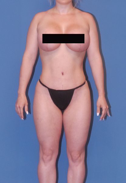 Abdominoplasty Before & After
