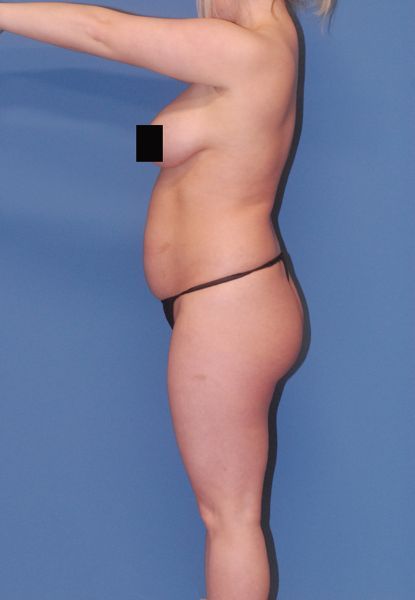 Abdominoplasty Before & After