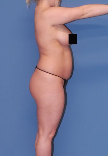 Abdominoplasty Before & After