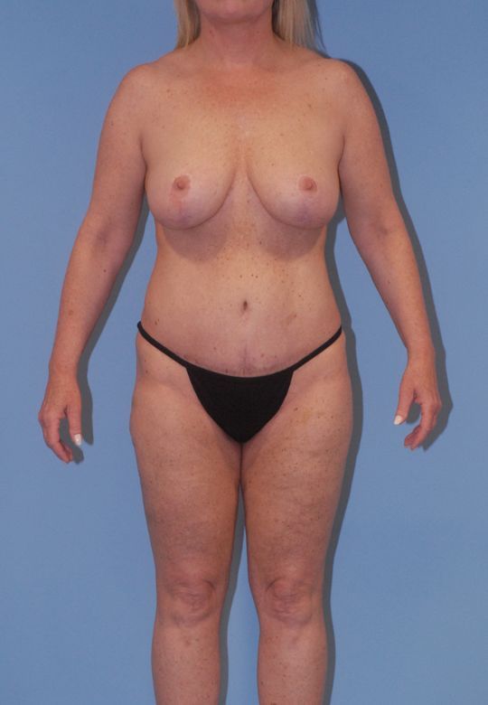 Abdominoplasty Before & After