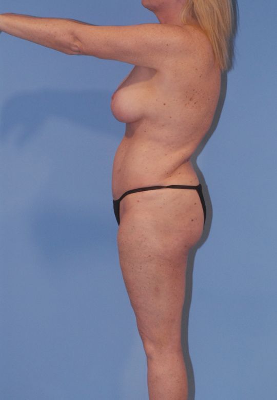 Abdominoplasty Before & After