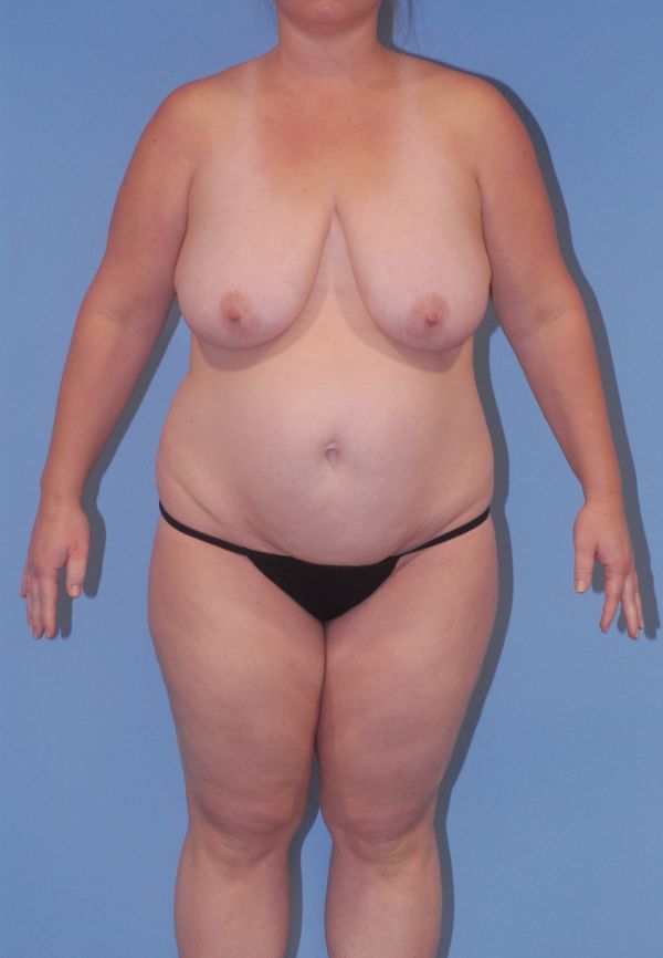 Abdominoplasty Before & After