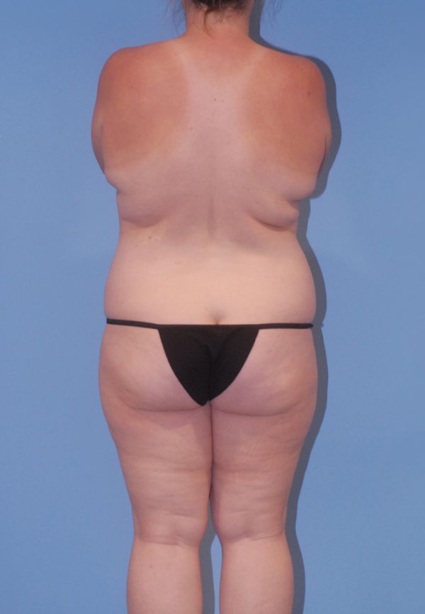 Abdominoplasty Before & After