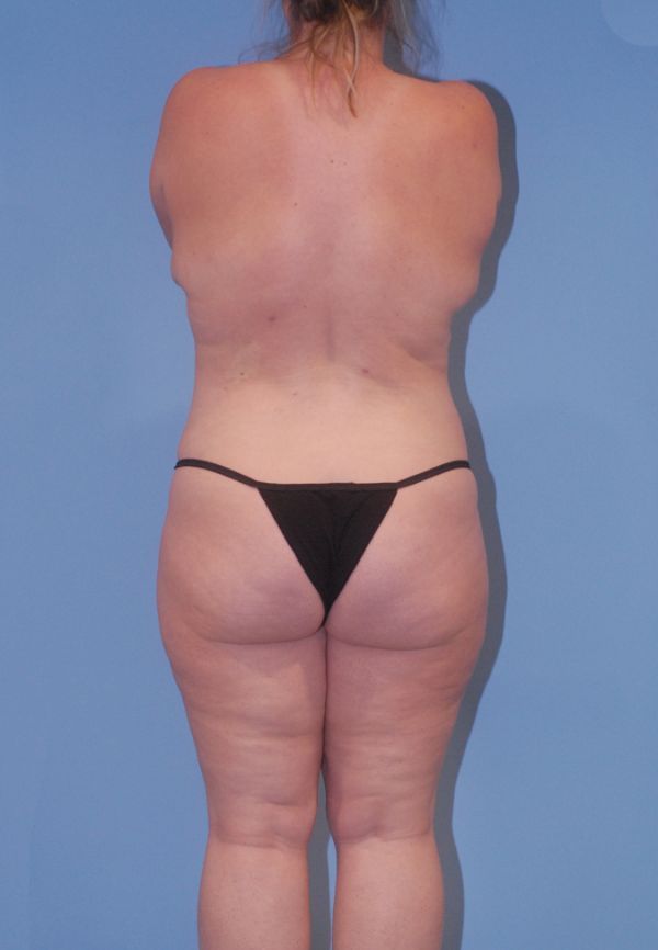 Abdominoplasty Before & After
