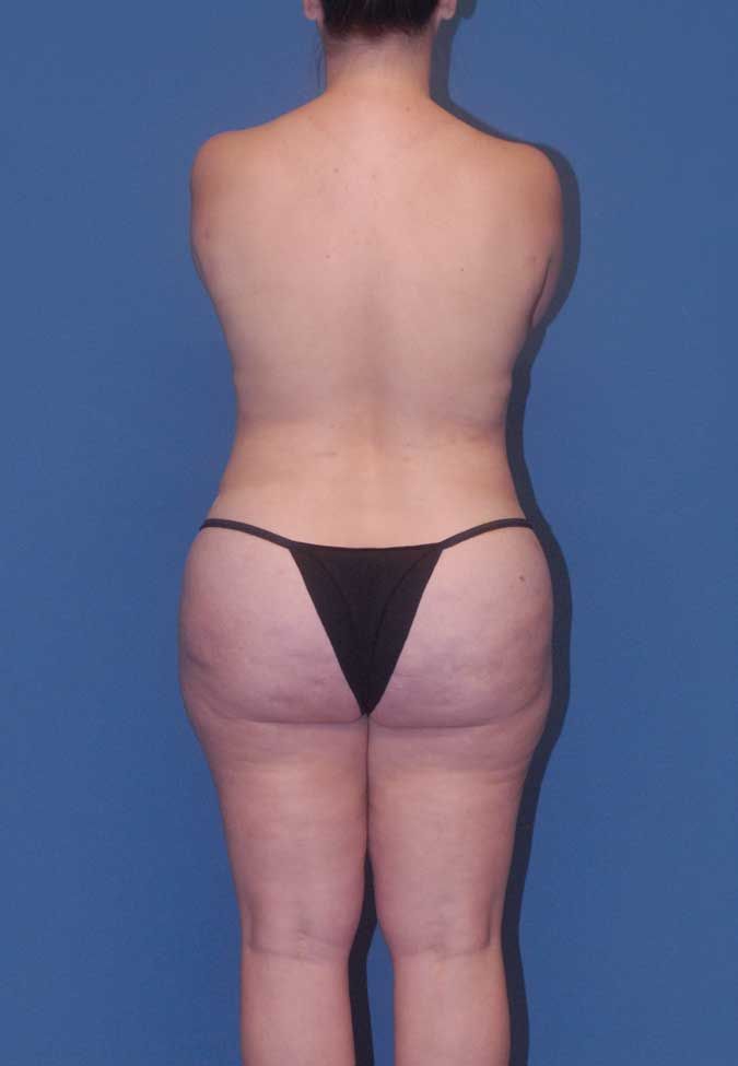 Abdominoplasty Before & After