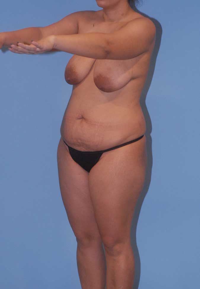 Abdominoplasty Before & After