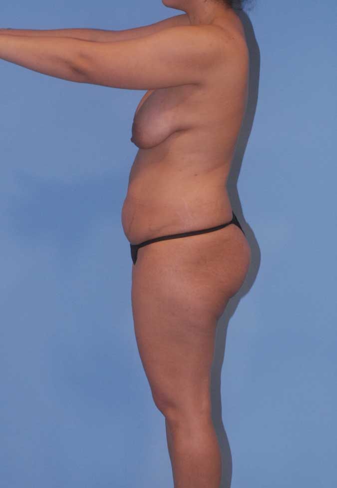 Abdominoplasty Before & After