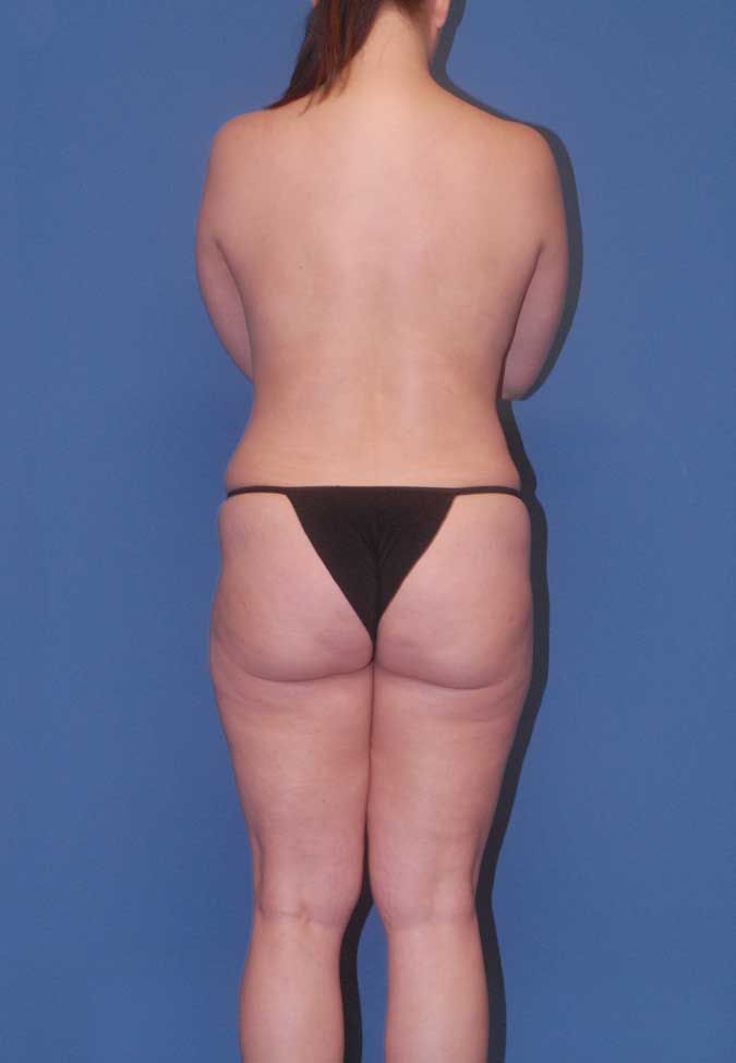 Abdominoplasty Before & After