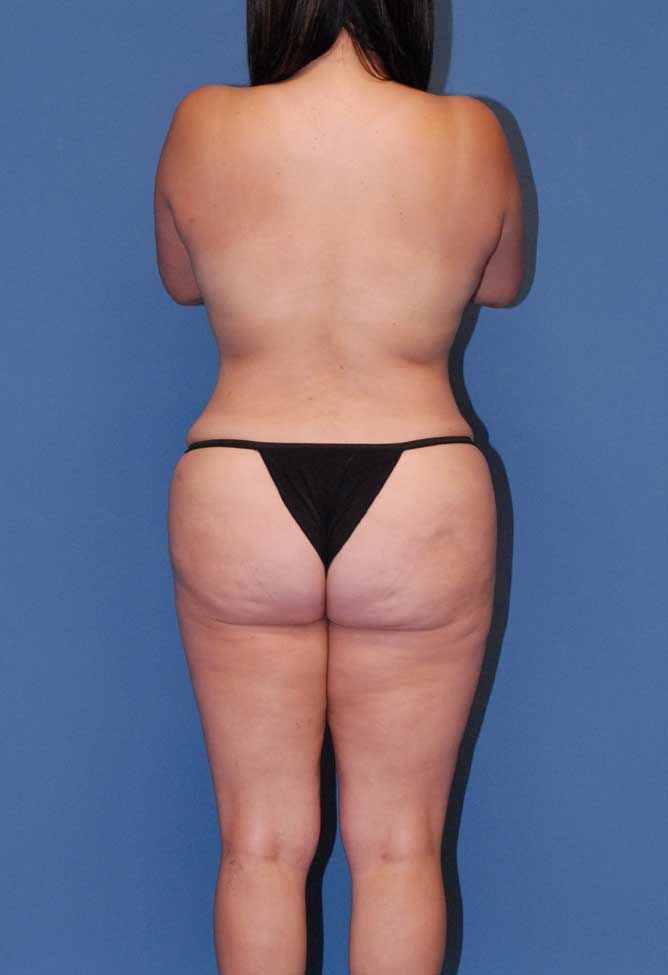 Abdominoplasty Before & After