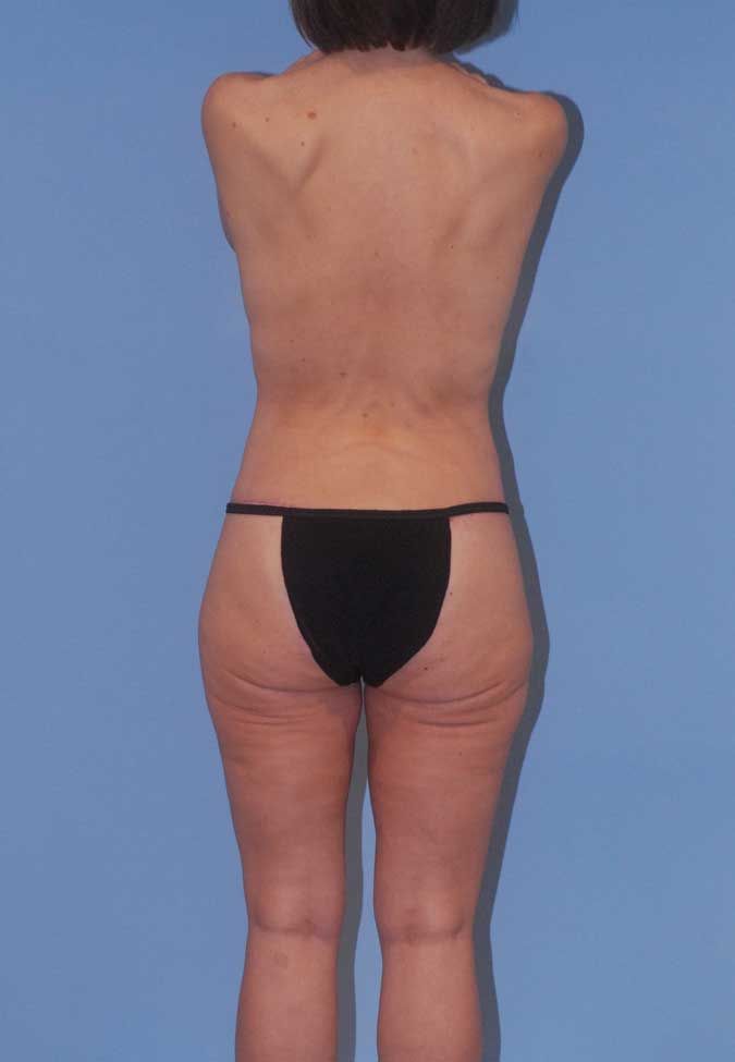 Abdominoplasty Before & After