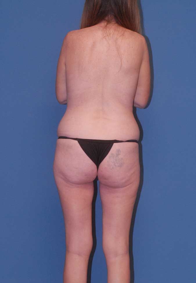 Abdominoplasty Before & After