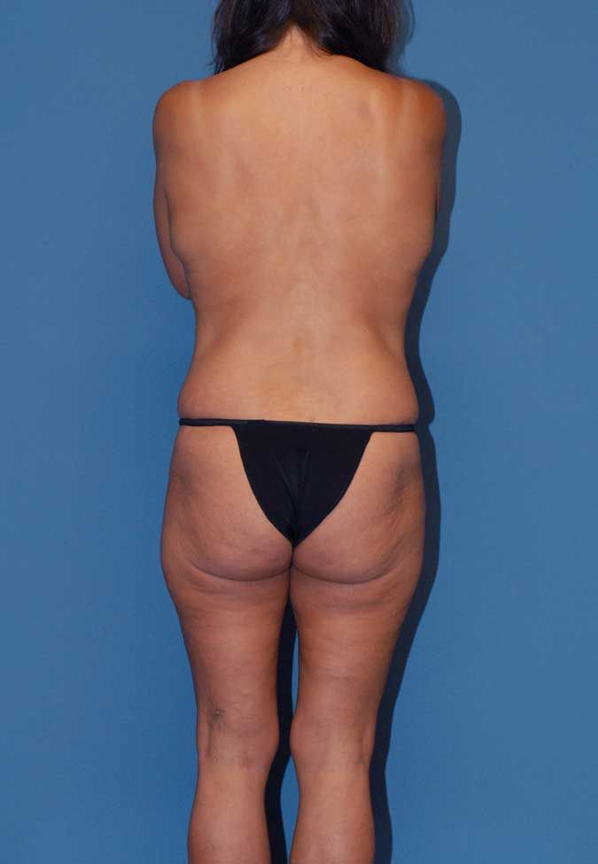 Abdominoplasty Before & After