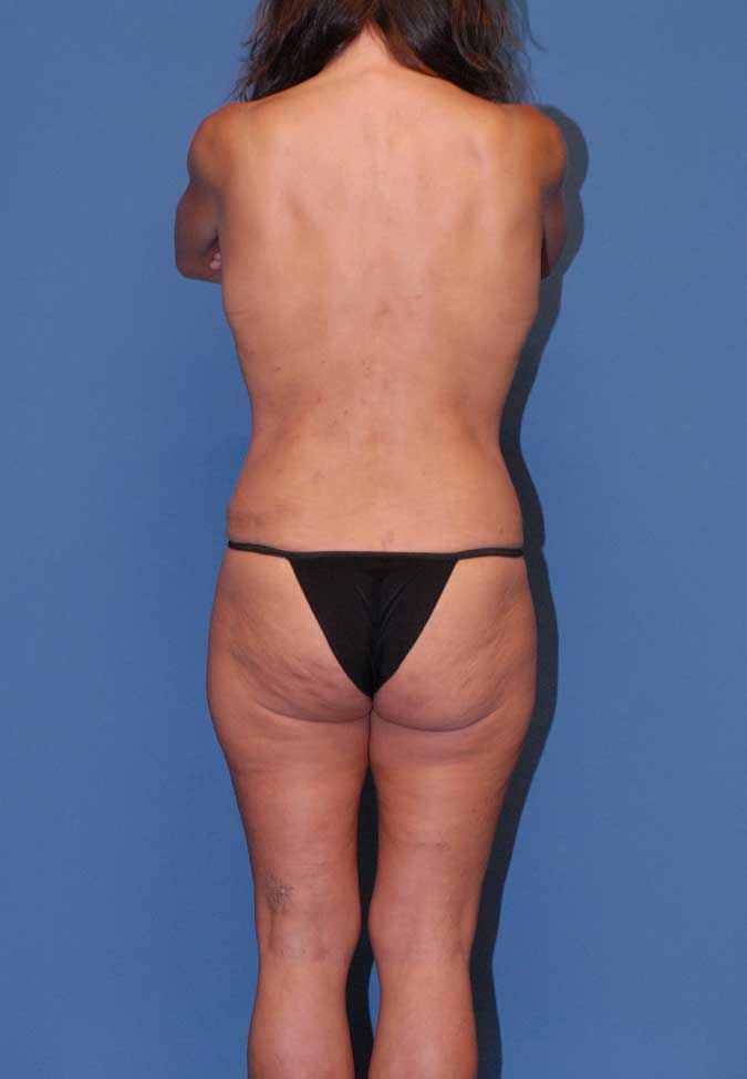 Abdominoplasty Before & After