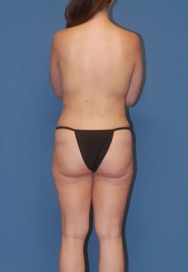 Abdominoplasty Before & After