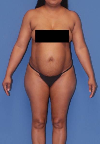 Abdominoplasty Before & After