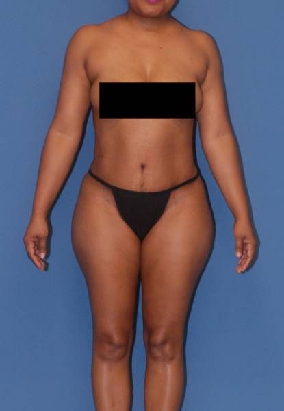 Abdominoplasty Before & After