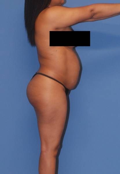 Abdominoplasty Before & After