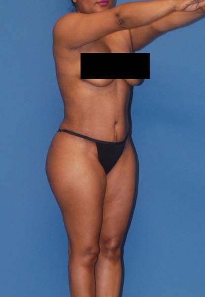 Abdominoplasty Before & After