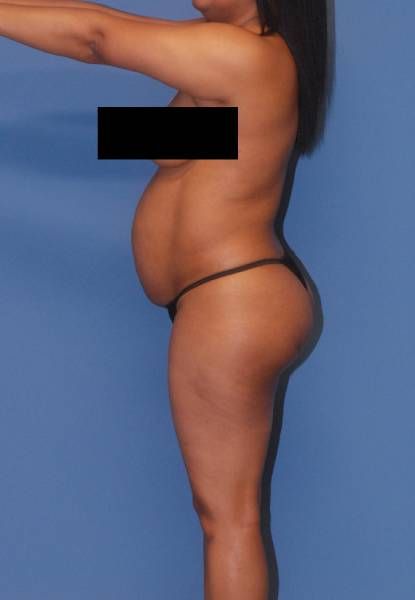 Abdominoplasty Before & After