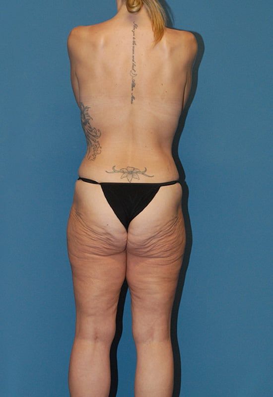 Abdominoplasty Before & After