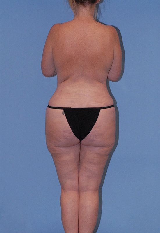 Abdominoplasty Before & After