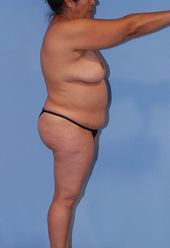 Abdominoplasty Before & After