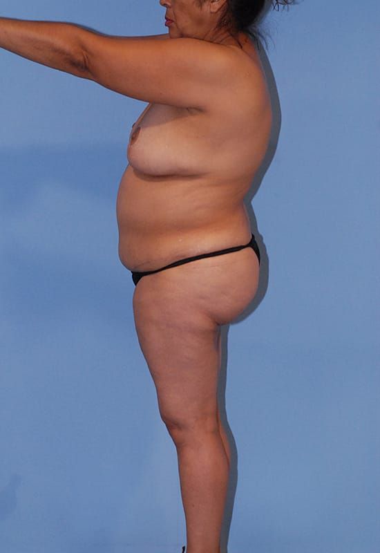 Abdominoplasty Before & After