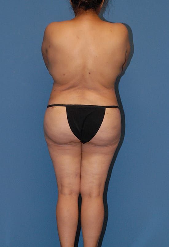 Abdominoplasty Before & After