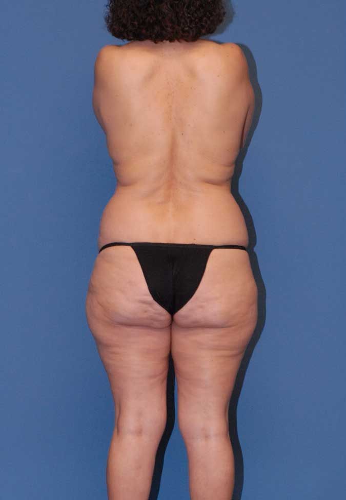 Abdominoplasty Before & After