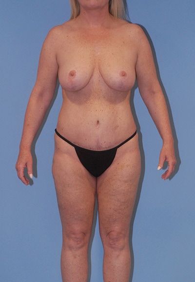 Abdominoplasty Before & After