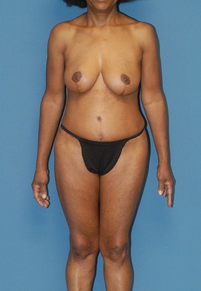 Abdominoplasty Before & After