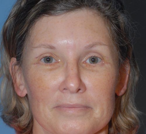 Brow Lift Before & After