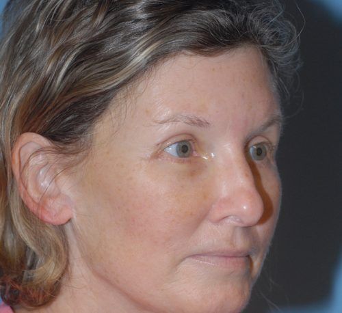 Brow Lift Before & After