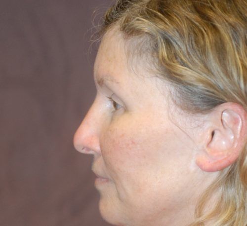 Brow Lift Before & After