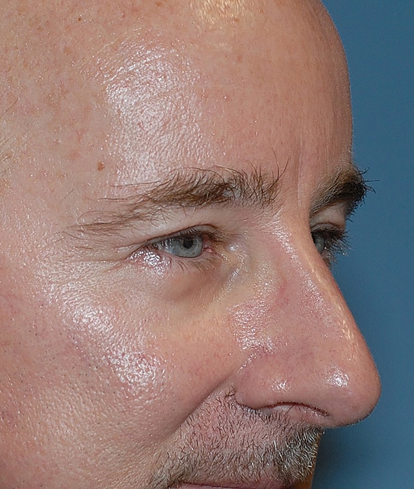 Brow Lift Before & After