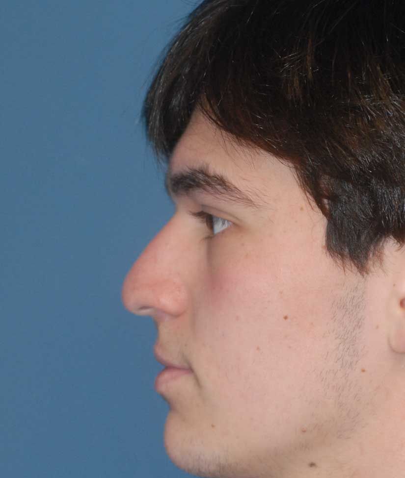 Rhinoplasty Before & After