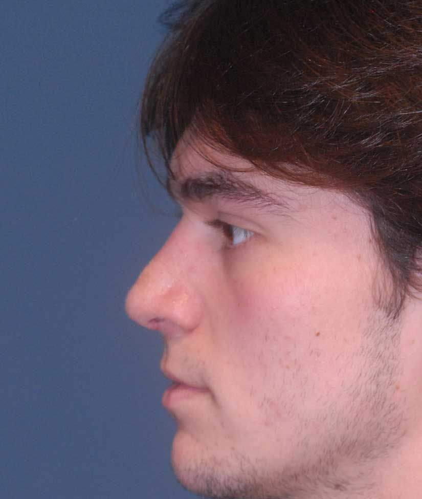 Rhinoplasty Before & After