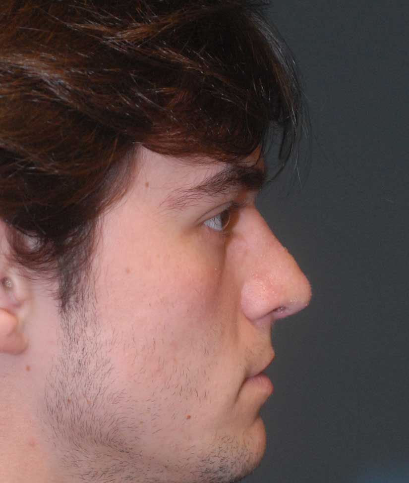 Rhinoplasty Before & After