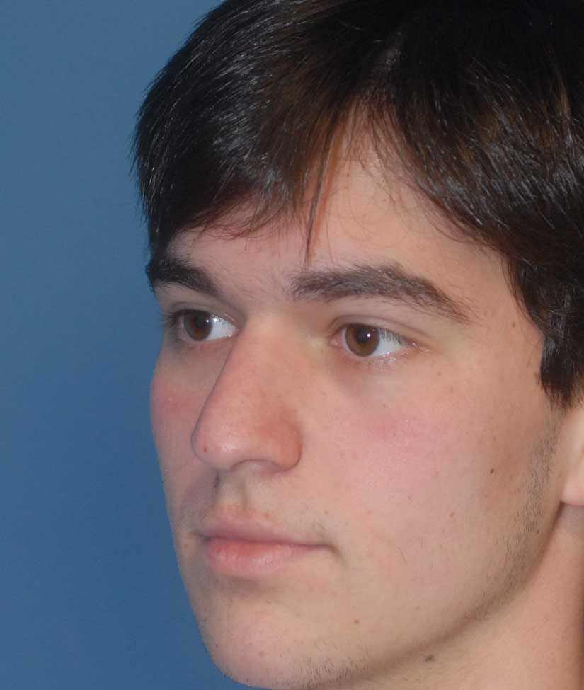 Rhinoplasty Before & After