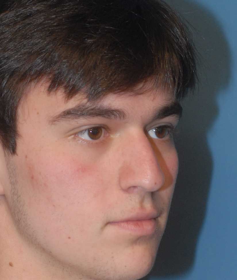 Rhinoplasty Before & After