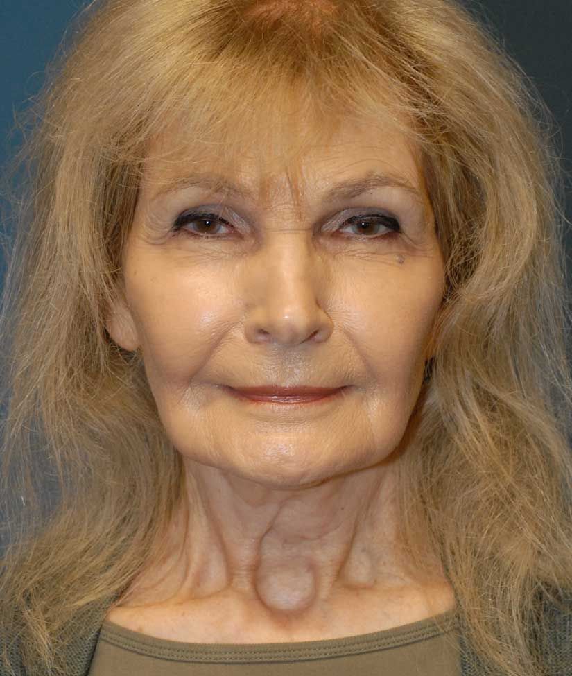 Facelift Before & After