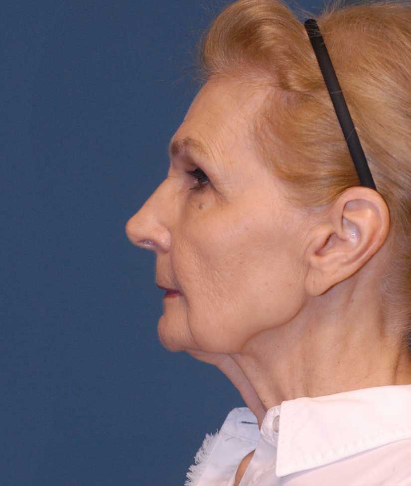 Facelift Before & After