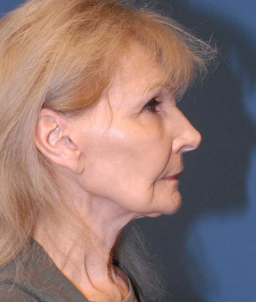 Facelift Before & After