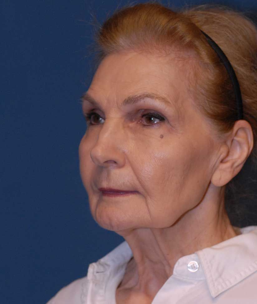 Facelift Before & After