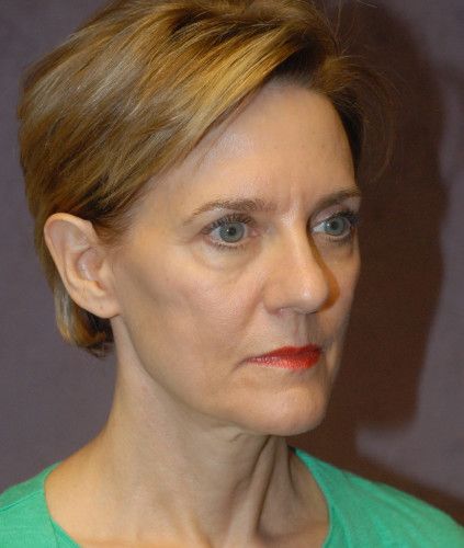 Facelift Before & After