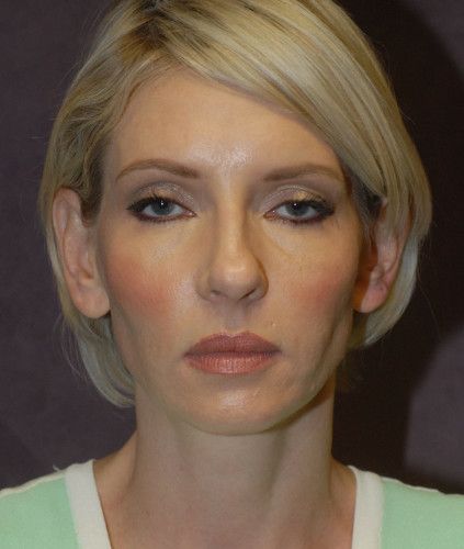 Facelift Before & After