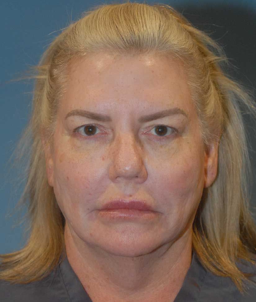 Facelift Before & After